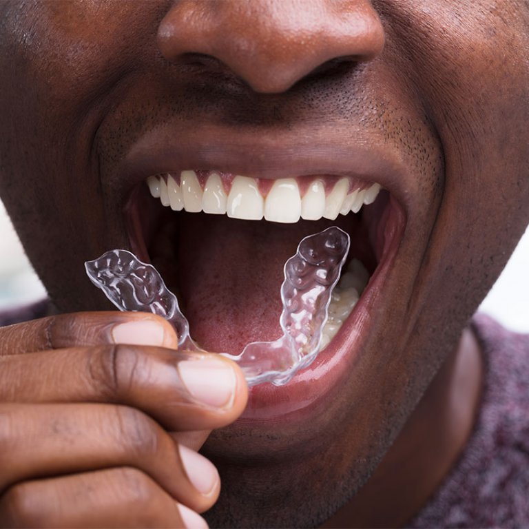 a man placing one half of his Invisalign aligners in his mouth