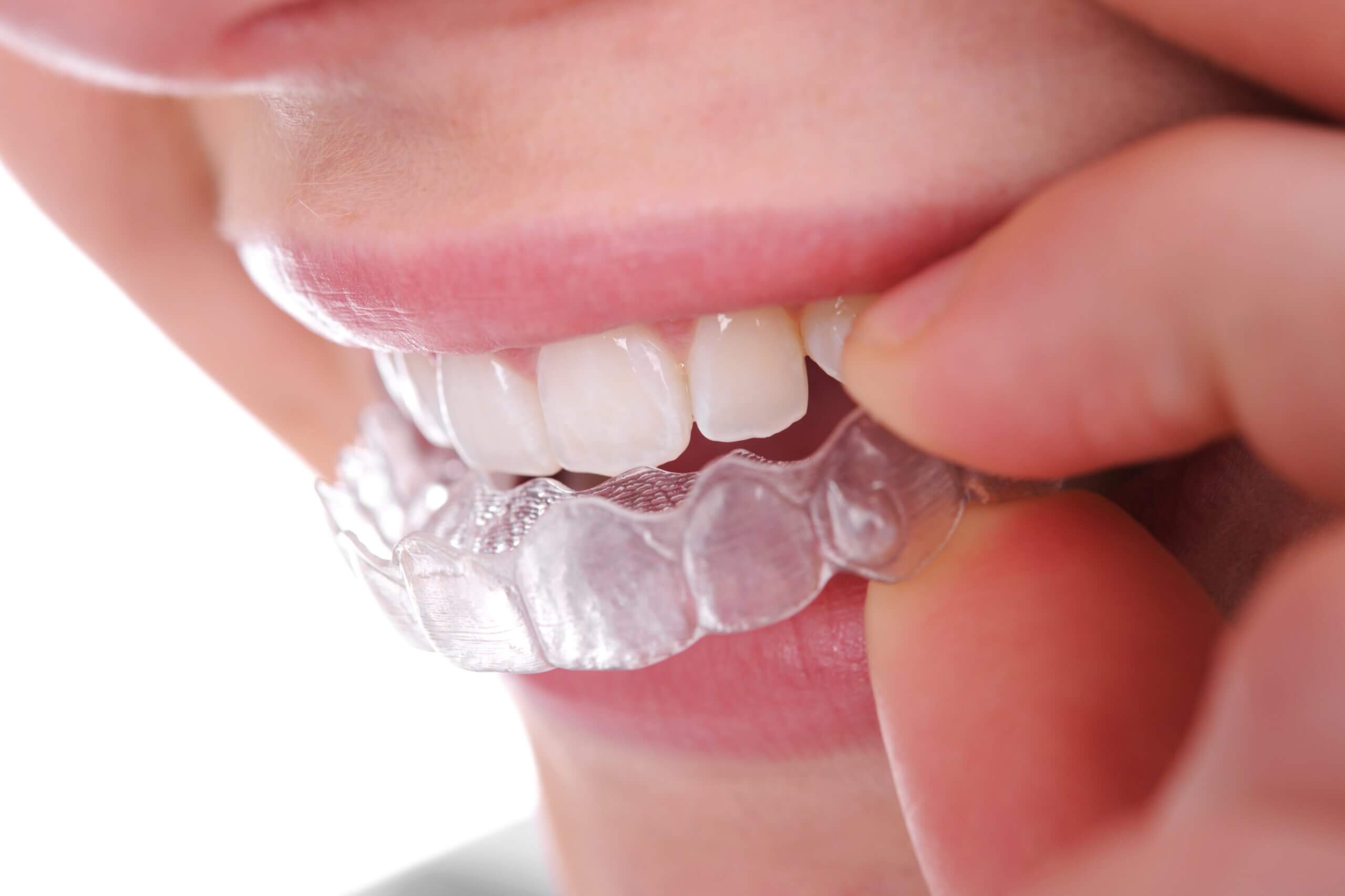 Invisalign braces