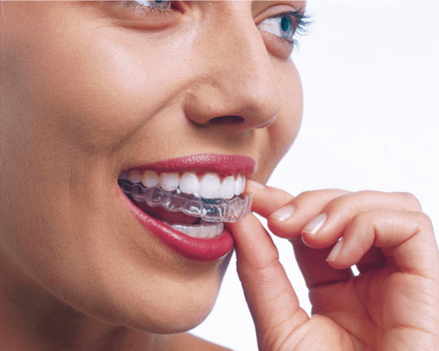 a women putting on invisalign retainers