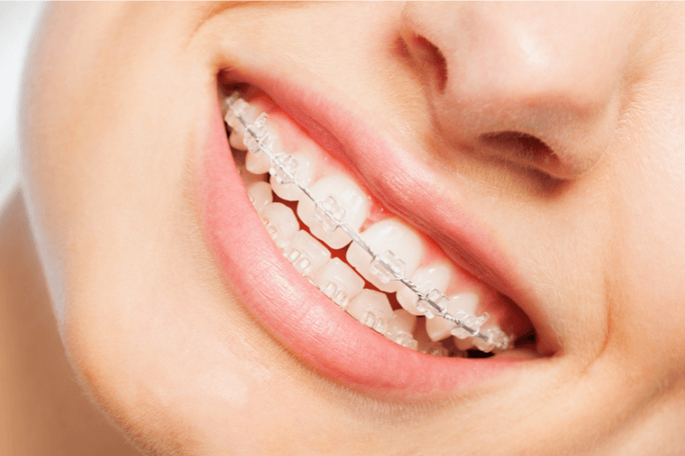 a woman smiling while wearing braces