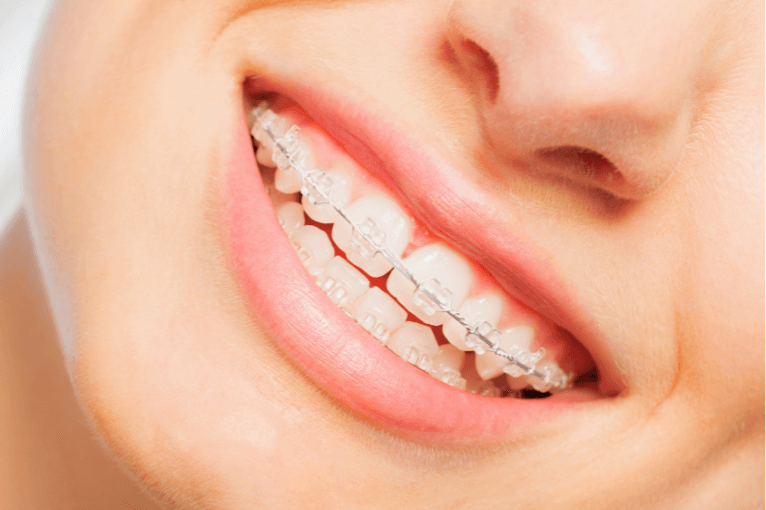 a person smiling with braces on